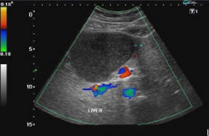 Разрыв печени на узи фото