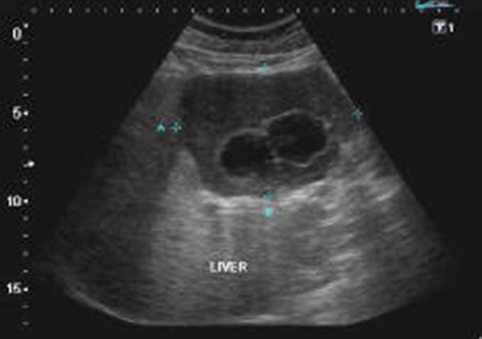Гидатидный эхинококкоз печени в ультразвуковом изображении характеризуется